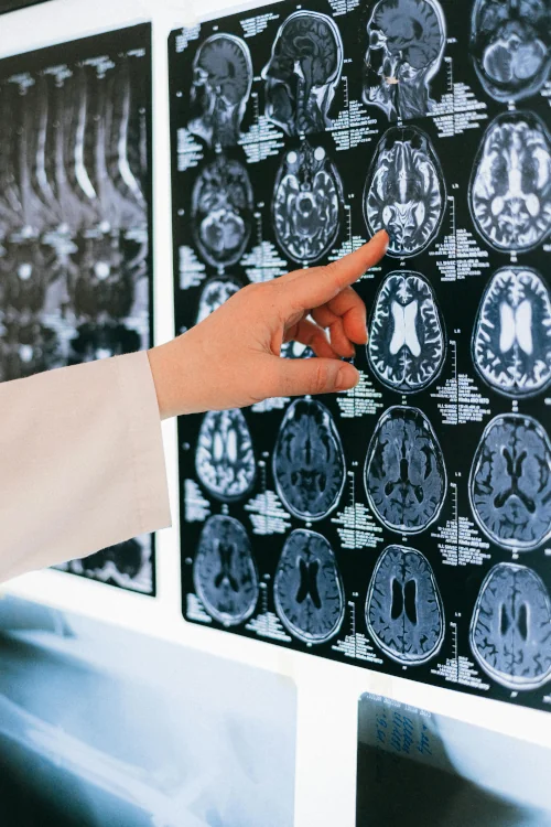 Microdosing Hirnaktivität Hirnaktivität auf Gehirnscans an der Wand